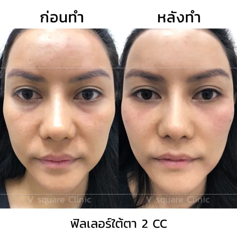 รีวิวฉีดฟิลเลอร์ใต้ตา 2 CC ที่ V Square Clinic