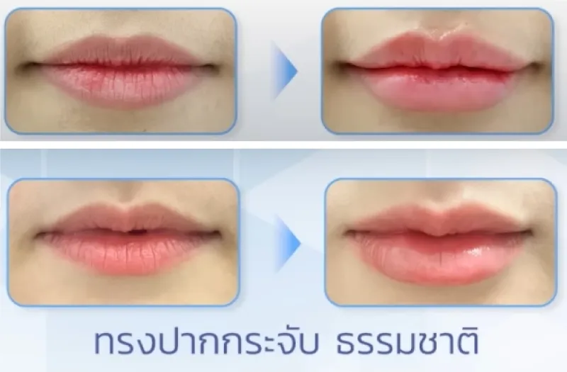 ฉีดฟิลเลอร์ปากราคา สายเกาหลี