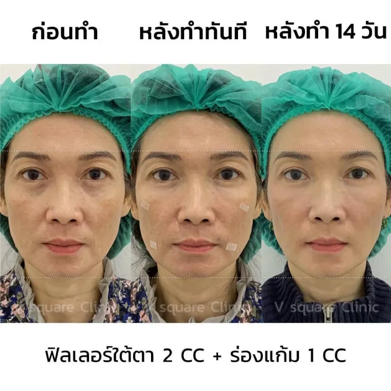 รีวิวฉีดฟิลเลอร์ร่องแก้ม 1 CC