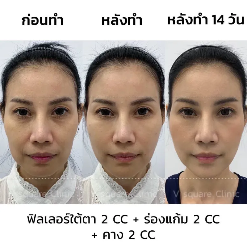 รีวิวฉีดฟิลเลอร์ร่องแก้ม 2 CC