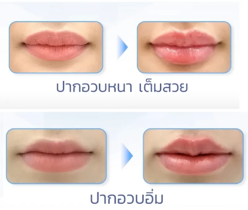 ฉีดฟิลเลอร์ปากราคา สายฝอ
