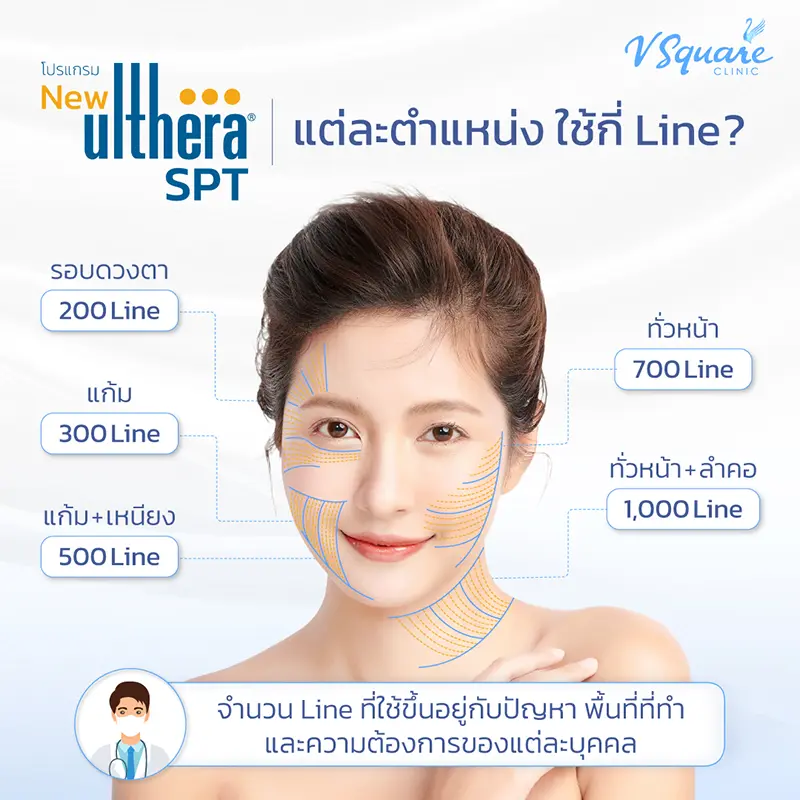 Ulthera ใช้กี่ไลน์