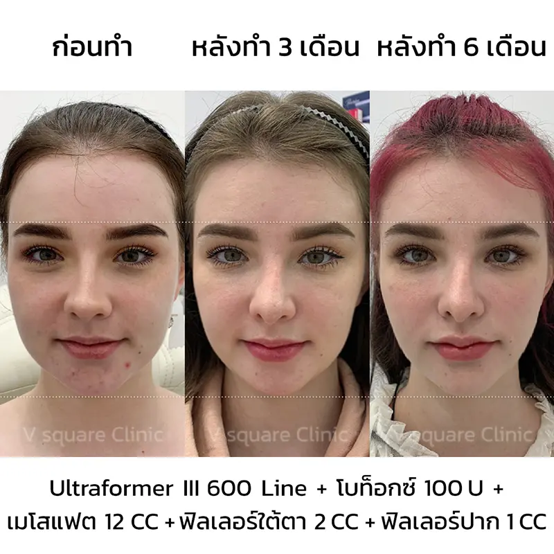 Ultraformer III รีวิว