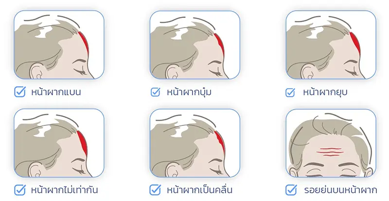 ฉีด Filler หน้าผาก ช่วยอะไร