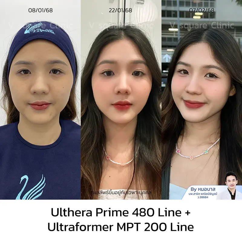 Ulthera ทั่วหน้า รีวิว_เอิร์น UL RR+MPT