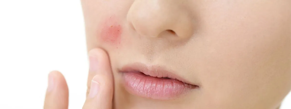  ฟิลเลอร์ปลอม - Filler หิ้ว อันตราย