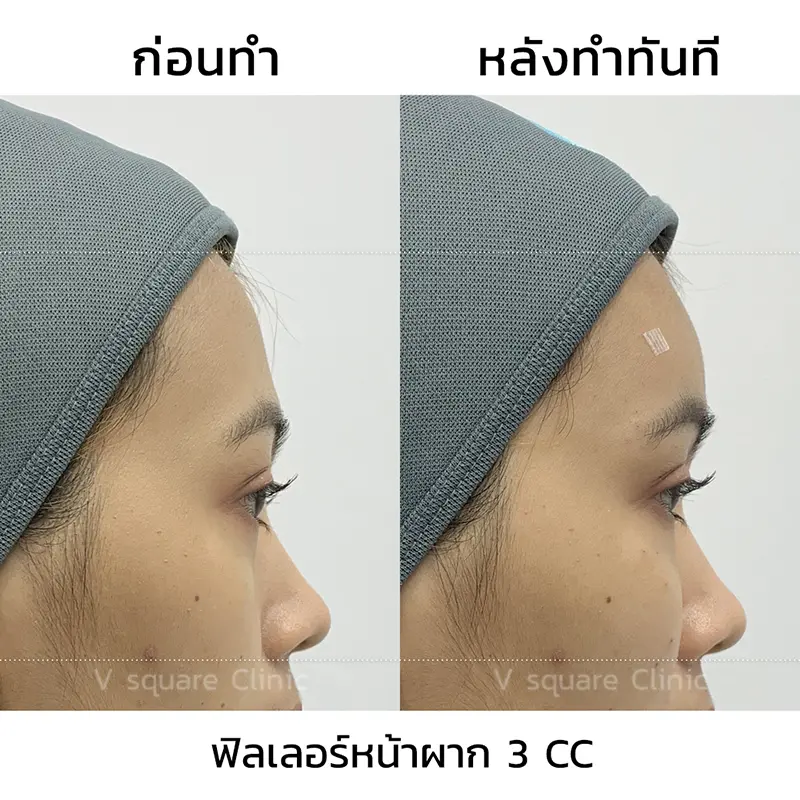 Filler หน้าผาก รีวิว_กีกี้