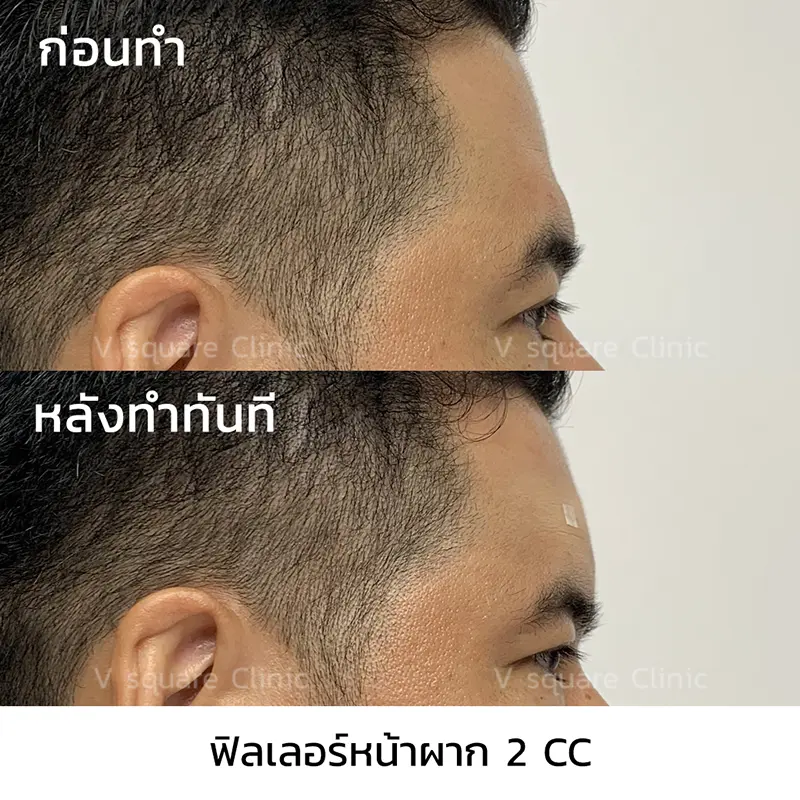 รีวิวเติมฟิลเลอร์หน้าผาก_คุณวูจู(Pronality)