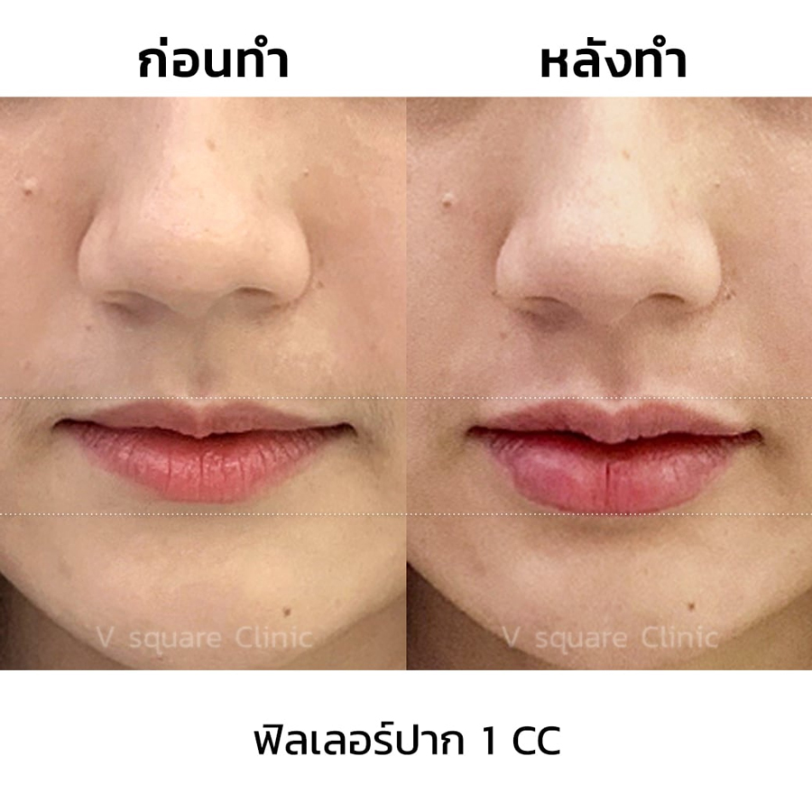 รีวิว ฉีดฟิลเลอร์ปาก เพิ่มความอวบอิ่ม