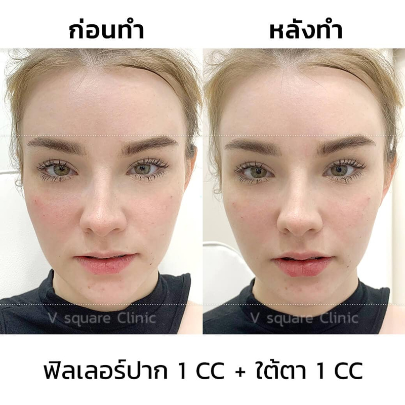 รีวิว ฉีดฟิลเลอร์ปาก เพิ่มความชุ่มชื้น