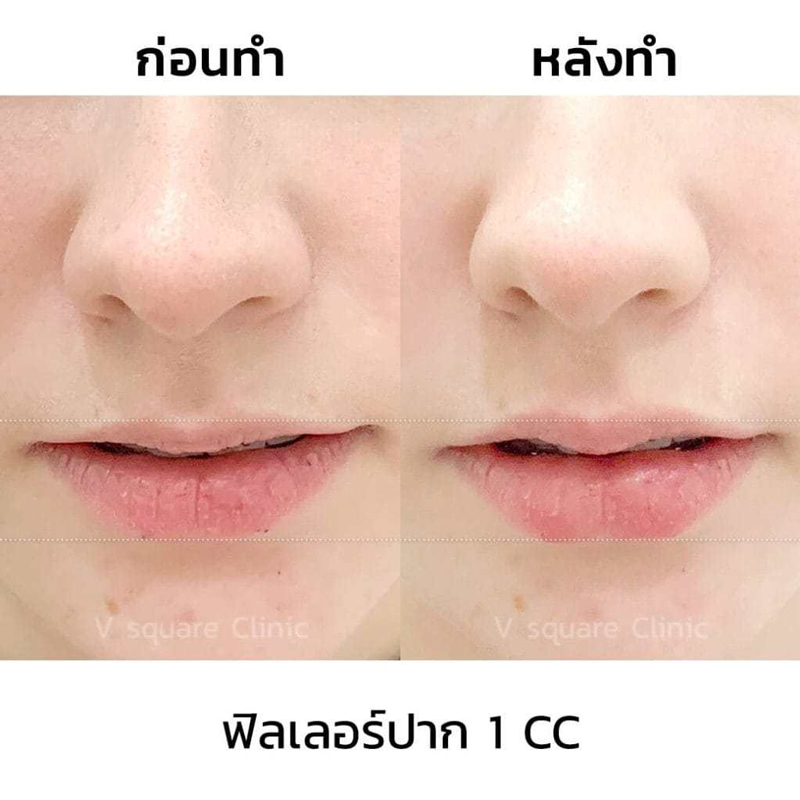 รีวิว ฉีดฟิลเลอร์ปาก เพิ่มความชุ่มชื้น