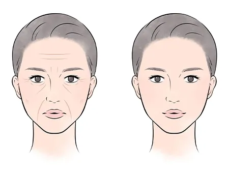 ฉีดโบลดริ้วรอย คืออะไร นิยมฉีดจุดไหน มีข้อดี-ข้อเสียอะไรบ้าง