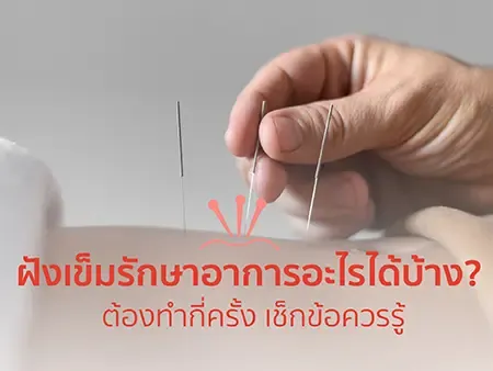 ฝังเข็มรักษาอาการอะไรได้บ้าง? ต้องทำกี่ครั้ง เช็กข้อควรรู้