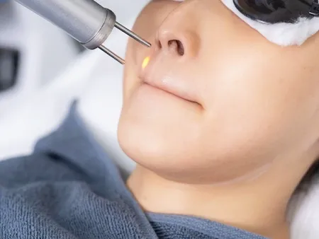 เลเซอร์หนวด ตัวช่วยเพิ่มความมั่นใจ ทำได้ทั้งผู้ชาย ผู้หญิง เลเซอร์หนวด ตัวช่วยเพิ่มความมั่นใจ ทำได้ทั้งผู้ชาย ผู้หญิง