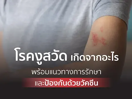 โรคงูสวัด