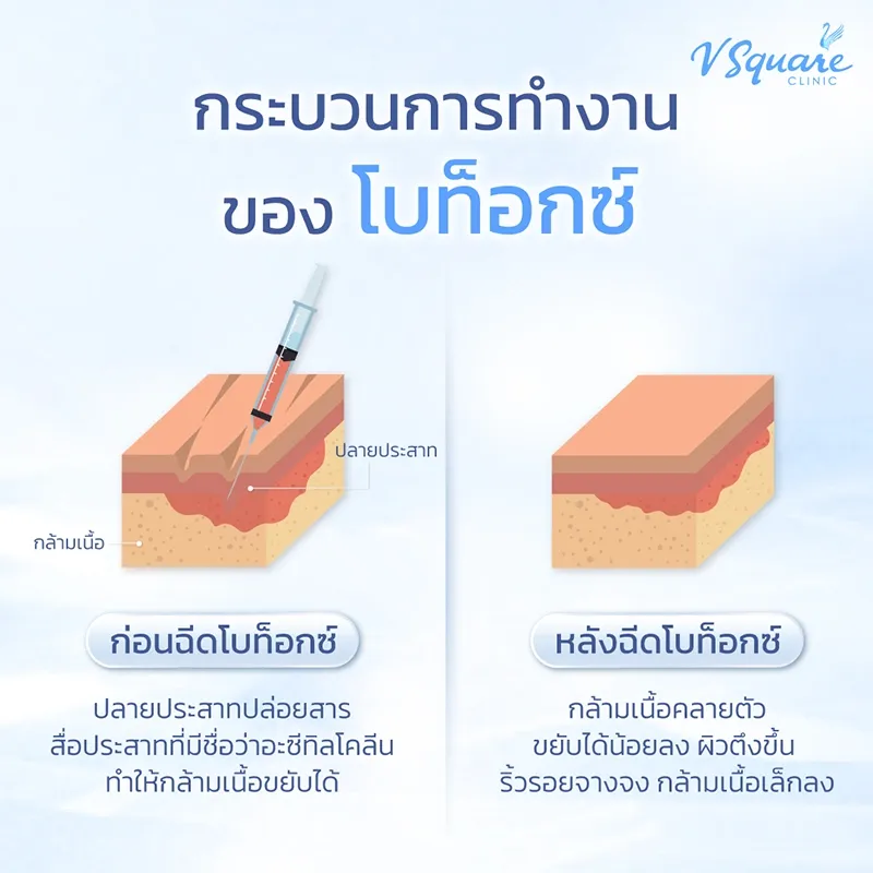 ฉีดโบท็อกกี่วันเห็นผล ? ริ้วรอย กราม ลดเหงื่อ กี่วันชัดเจน ? ฉีดโบท็อกกี่วันเห็นผล ? ริ้วรอย กราม ลดเหงื่อ กี่วันชัดเจน ?