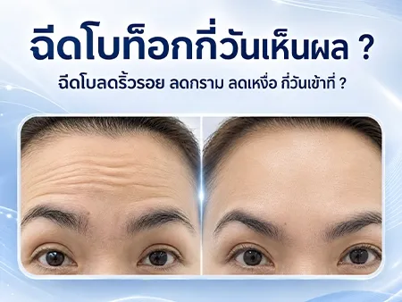 ฉีดโบท็อกกี่วันเห็นผล ? ฉีดโบลดริ้วรอย ลดกราม ลดเหงื่อ กี่วันเข้าที่ ขึ้นกับปัจจัยใดบ้าง ?