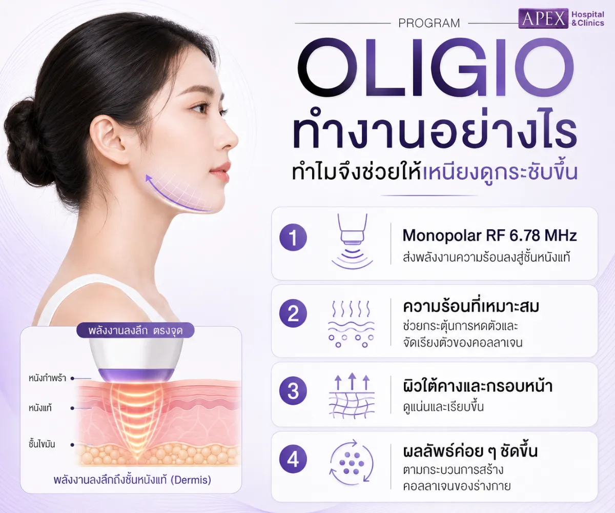 Oligio ลดเหนียงได้ไหม ต้องทำกี่ช็อตจึงจะช่วยให้เหนียงลด 