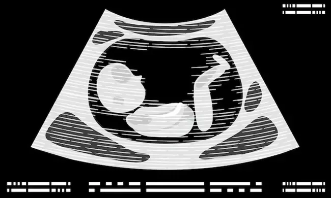 อัลตร้าซาวด์ 