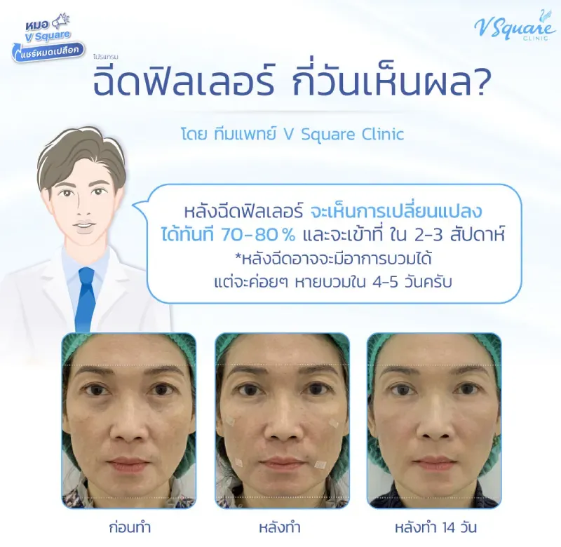 รีวิวหลังฉีดฟิลเลอร์ใต้ตา