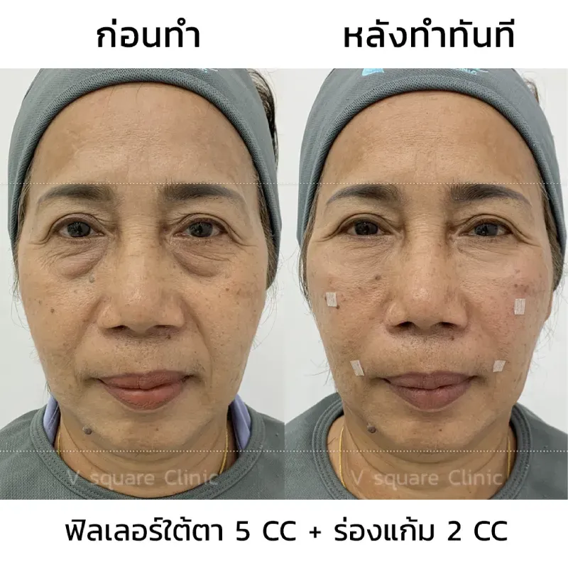 รีวิวฟิลเลอร์ลดถุงใต้ตา