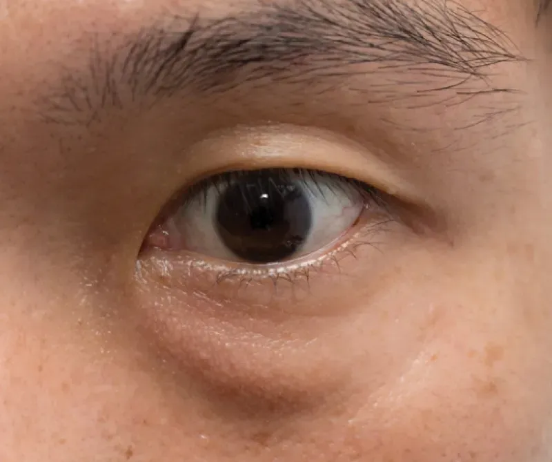 ลักษณะฉีดฟิลเลอร์ใต้ตาแล้วเป็นก้อน ลักษณะฉีดฟิลเลอร์ใต้ตาแล้วเป็นก้อน