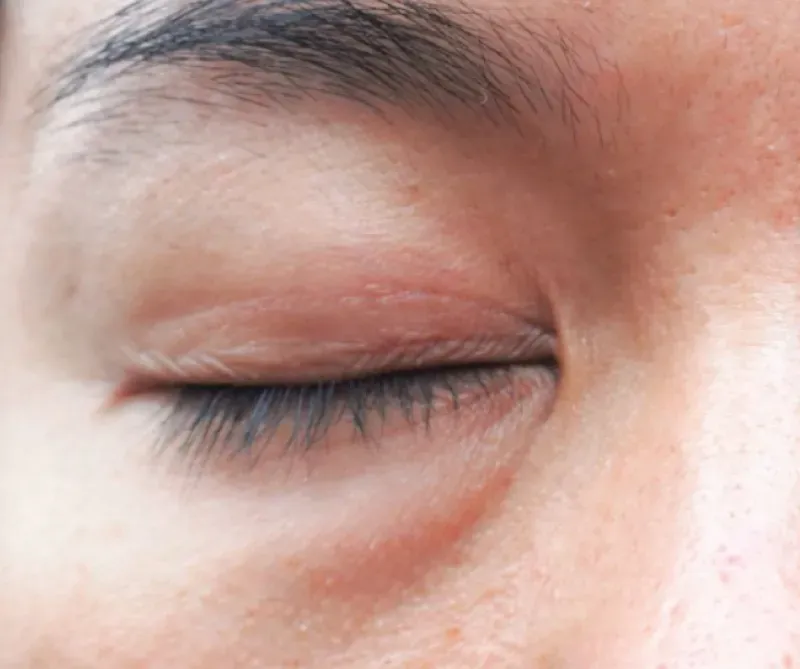 ใต้ตาเป็นก้อน-เป็นลำ ใต้ตาเป็นก้อน-เป็นลำ