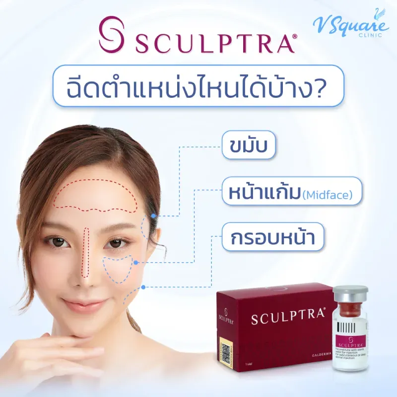 Sculptra ฉีดจุดไหนได้บ้าง