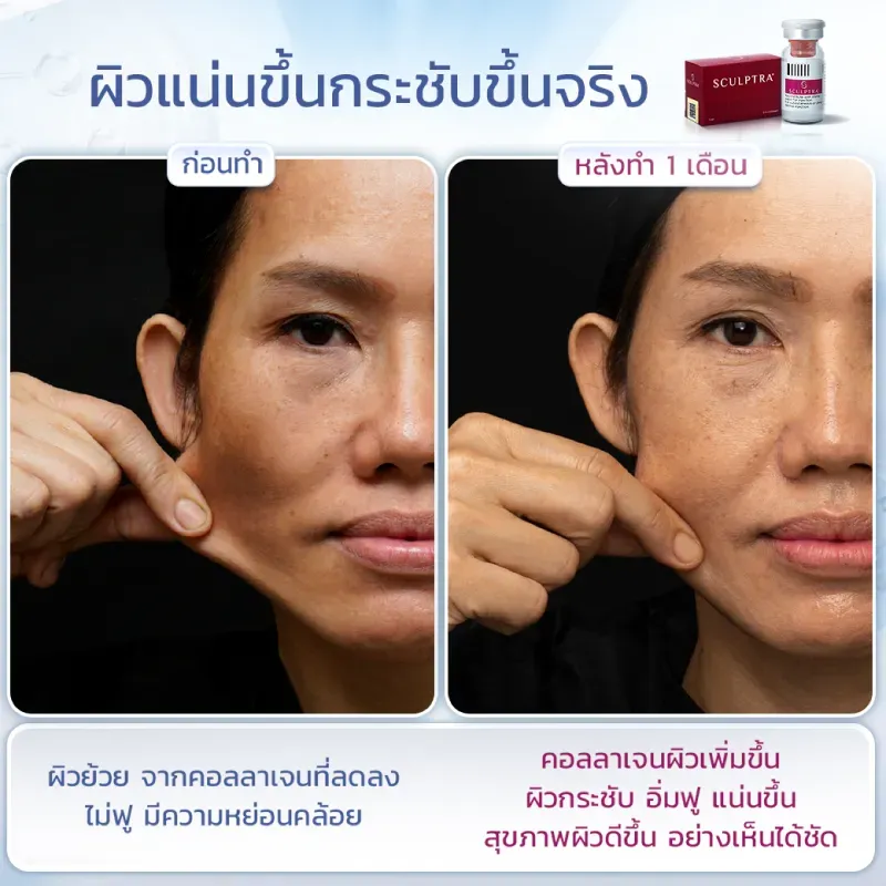 Sculptra รีวิวหลังทำ 1 เดือน
