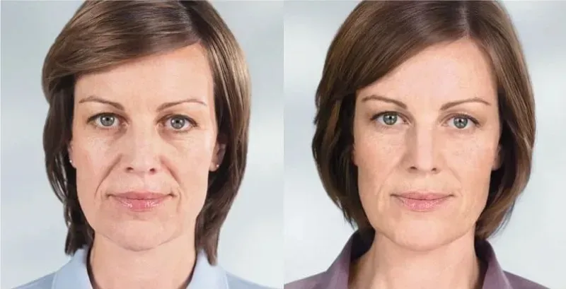 Sculptra รีวิวหลังทำ