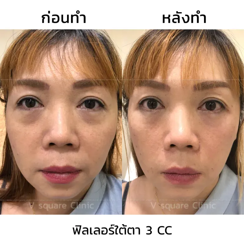 รีวิวฟิลเลอร์ใต้ตาลึก