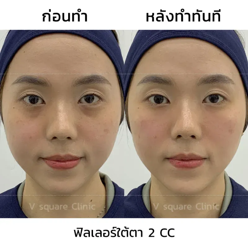รีวิวฉีดฟิลเลอร์ใต้ตา 2 CC ที่ V Square Clinic