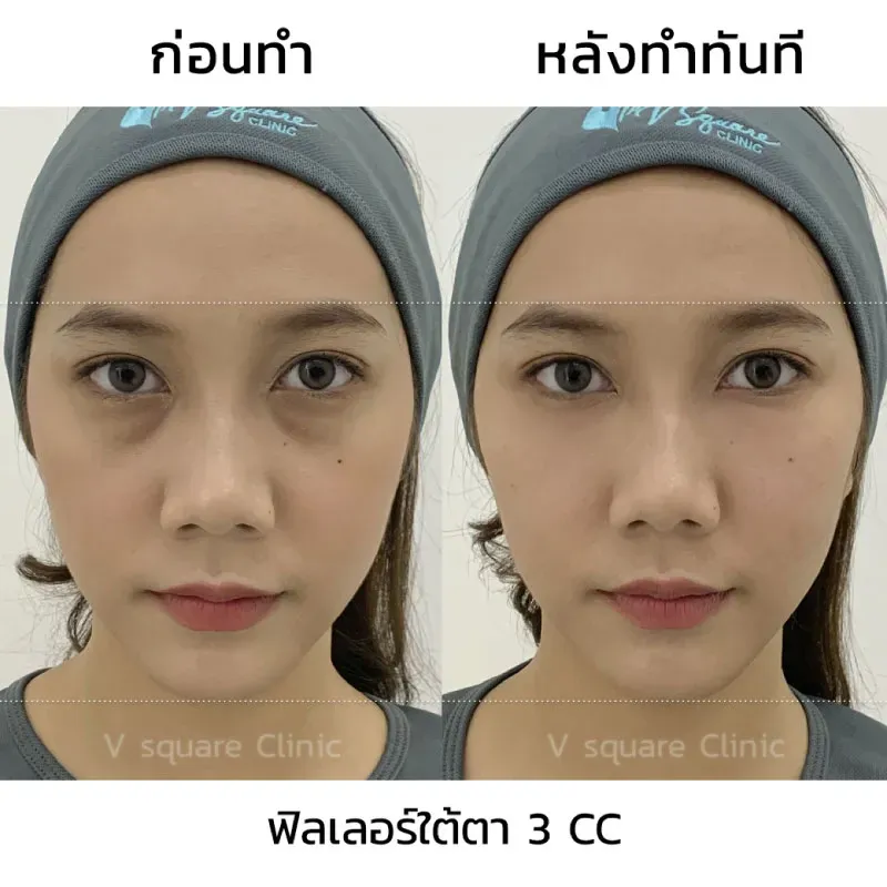 รีวิวฉีดฟิลเลอร์ใต้ตา 3 CC ที่ V Square Clinic