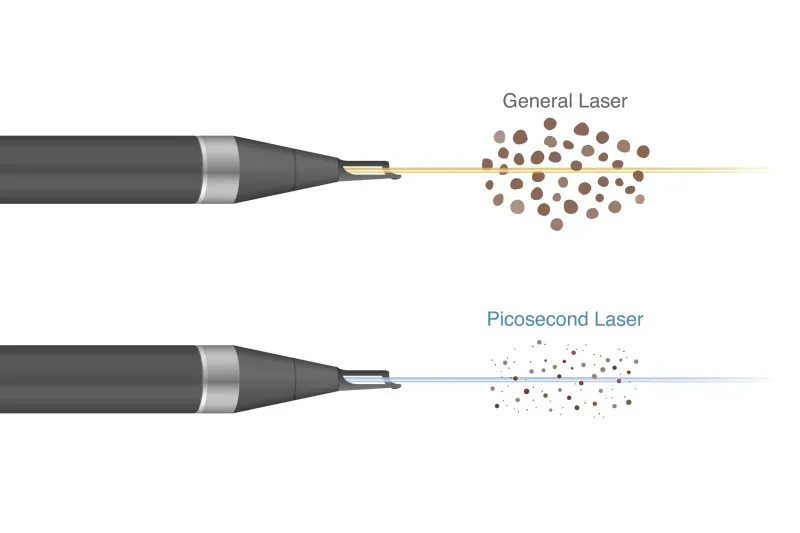 pico laser คือ pico laser คือ