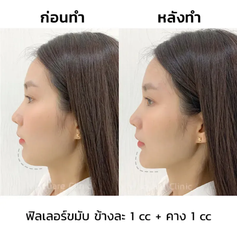 ฉีดฟิลเลอร์คาง 1 CC รีวิว