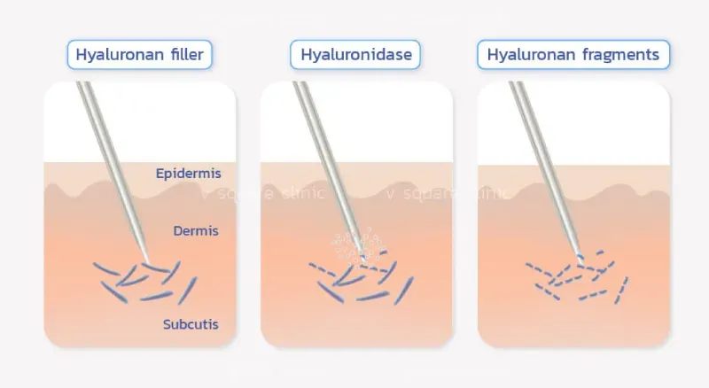 ฉีดสลายฟิลเลอร์ ฉีดสลายฟิลเลอร์