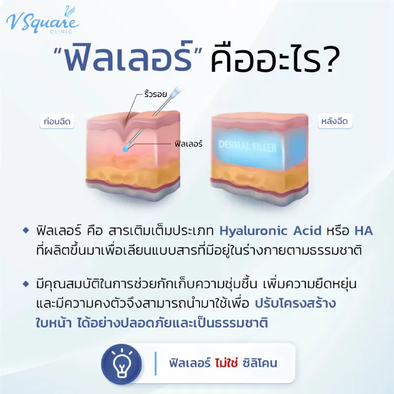 ฉีดฟิลเลอร์