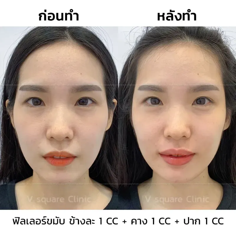 รีวิวฟิลเลอร์