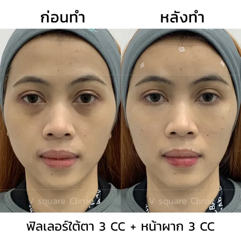 รีวิวฟิลเลอร์