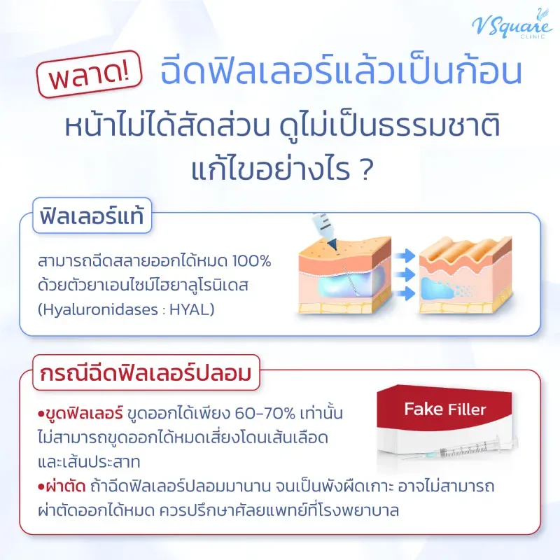 แก้หลังฉีดฟิลเลอร์ปากเป็นก้อน