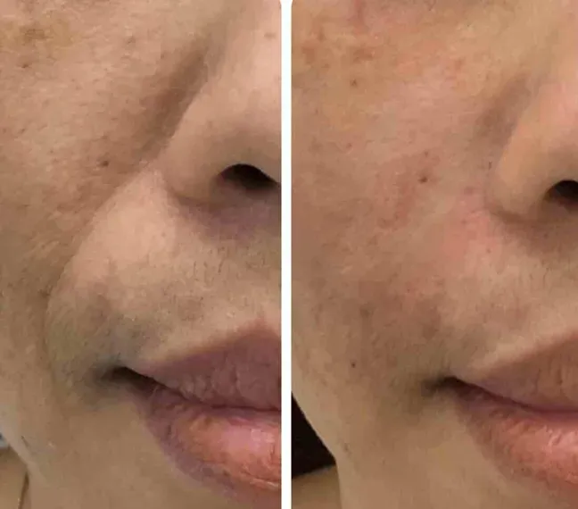 หลังฉีดฟิลเลอร์ร่องแก้มบวมเล็กน้อย 