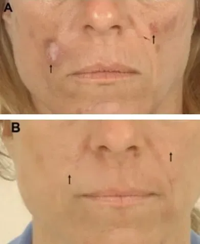 ฉีดฟิลเลอร์ร่องแก้มบวมเป็นก้อน