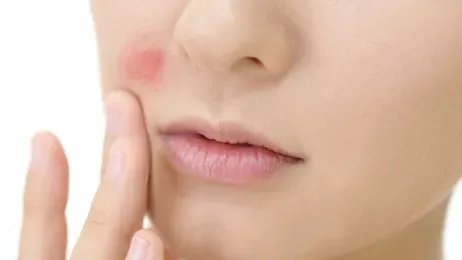 ฉีดฟิลเลอร์ร่องแก้มแล้วเป็นก้อน