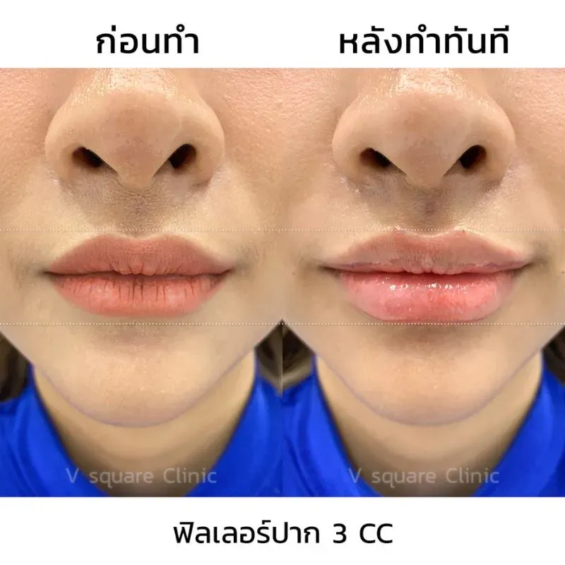 รีวิวฉีดฟิลเลอร์ปาก