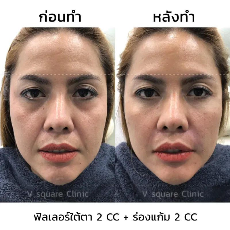 รีวิวฉีดฟิลเลอร์ร่องแก้ม2CC