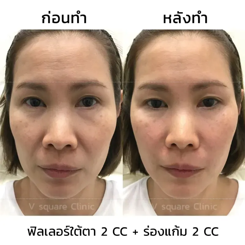 รีวิวฉีดฟิลเลอร์ร่องแก้ม