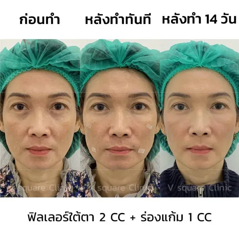 รีวิวฉีดฟิลเลอร์ร่องแก้ม 1 CC รีวิวฉีดฟิลเลอร์ร่องแก้ม 1 CC