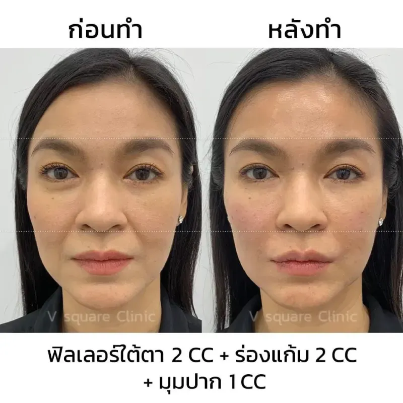 รีวิวฉีดฟิลเลอร์ร่องแก้ม+ใต้ตา