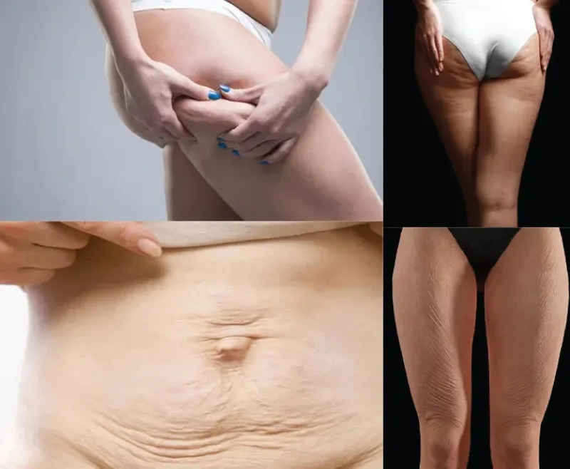 ฉีด Sculptra Body จุดไหนได้บ้าง