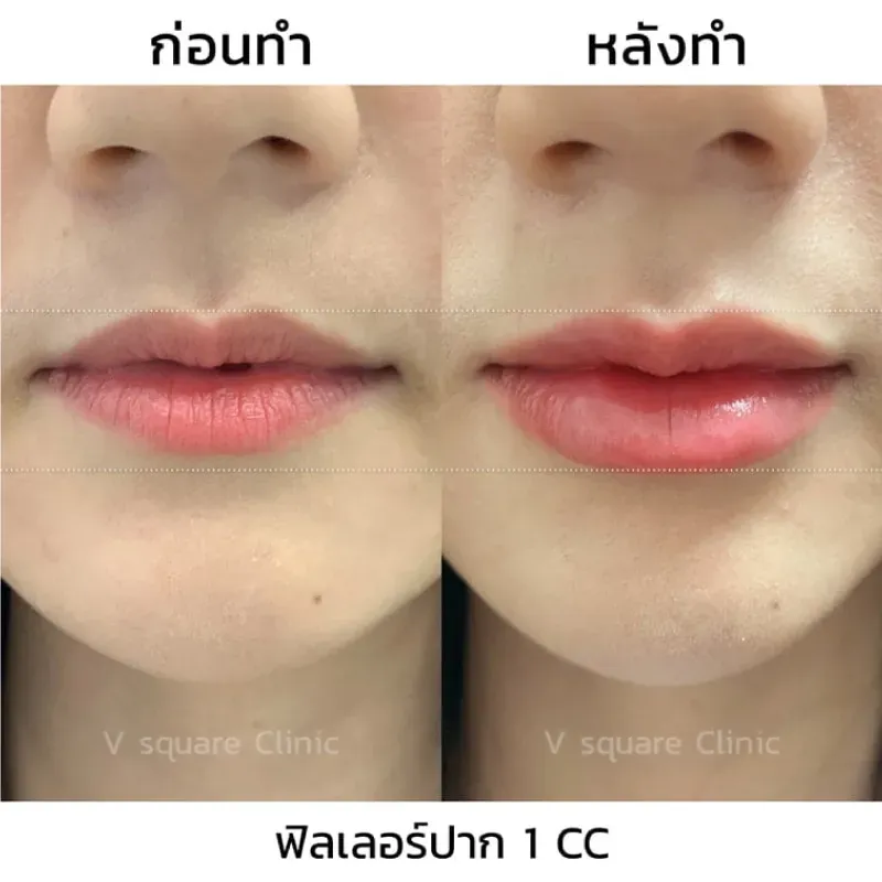 รีวิวฉีดฟิลเลอร์ปาก 1 CC